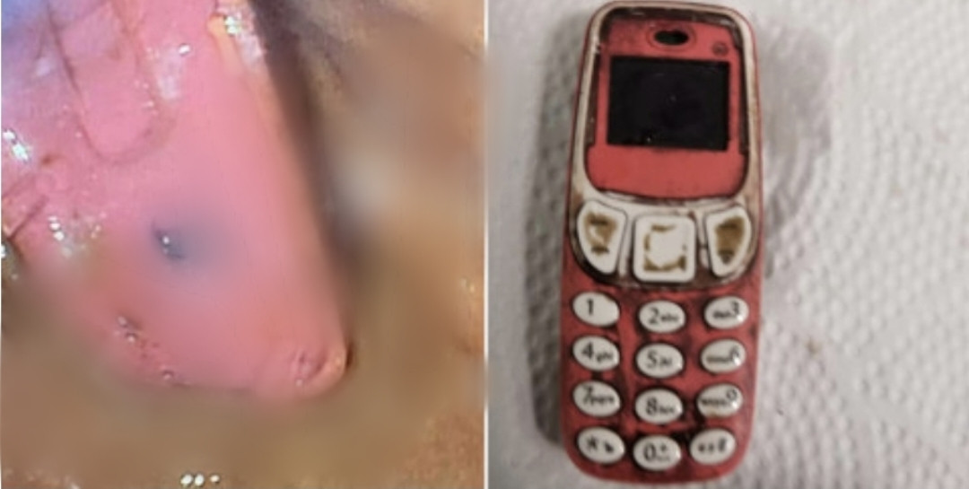 Surgeons Operate on Man After swallowing Nokia 3310 phone (PHOTOS)