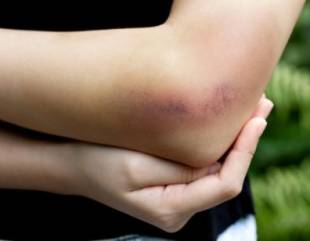 5 possible causes of easy & frequent bruising