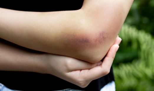 5 possible causes of easy & frequent bruising