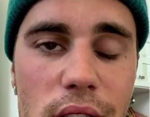 Justin Bieber Reveals That Half Of His Face Is Paralyzed Due To A Rare Disorder (Video)