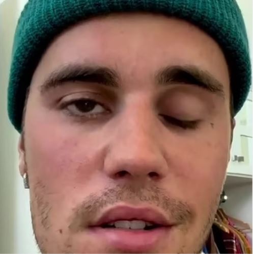 Justin Bieber Reveals That Half Of His Face Is Paralyzed Due To A Rare Disorder (Video)