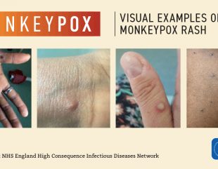 <strong>Monkeypox Cases Rise To 220 – NCDC</strong>