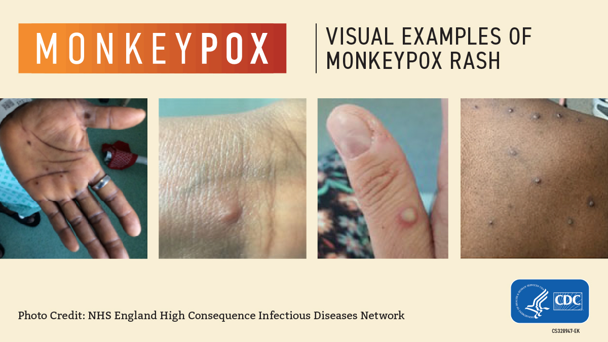 <strong>Monkeypox Cases Rise To 220 – NCDC</strong>