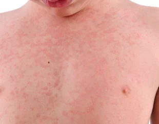 UK Declares ‘National Incident’ Over Measles Outbreak – Urgent Measures Implemented to Address the Health Crisis