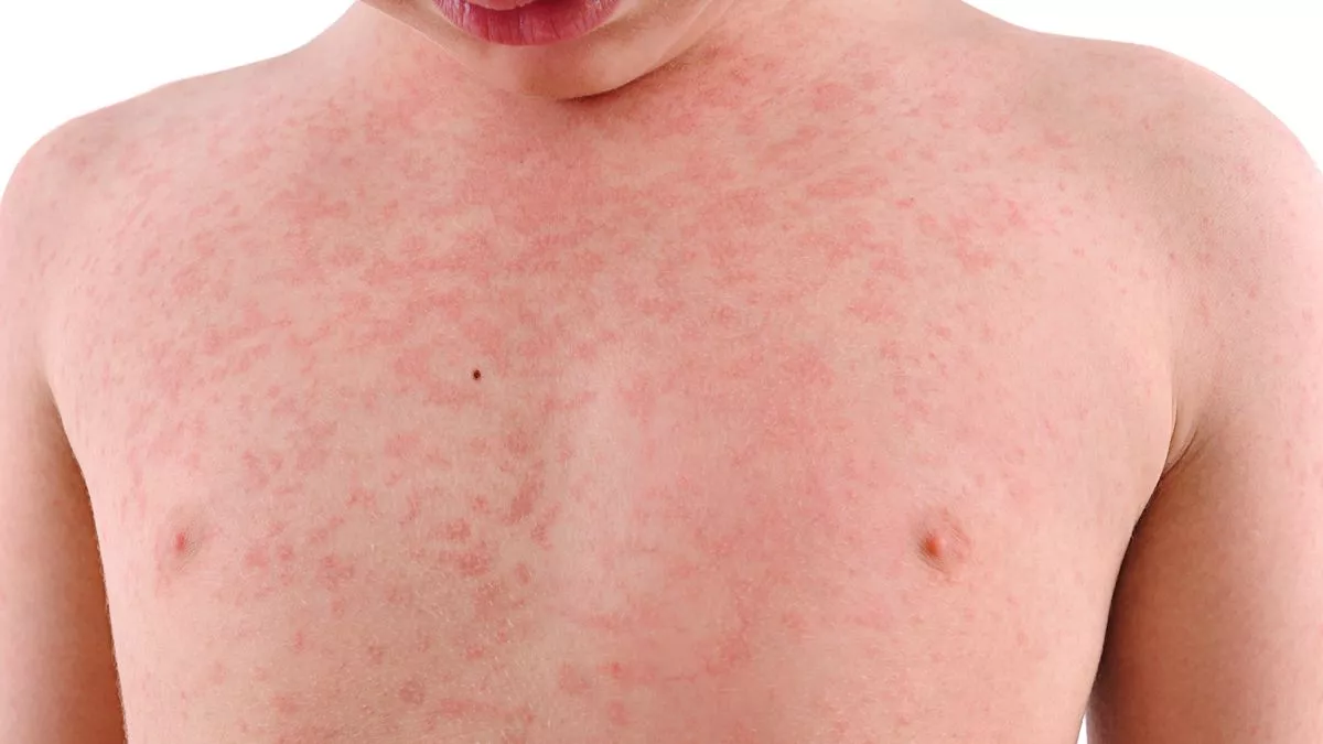 UK Declares ‘National Incident’ Over Measles Outbreak – Urgent Measures Implemented to Address the Health Crisis