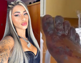 Influencer Faces Uncertain Future After Participating in Online ‘Challenge’ That Left Her Feet Black