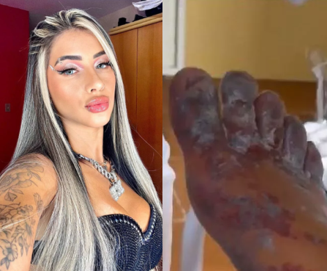 Influencer Faces Uncertain Future After Participating in Online ‘Challenge’ That Left Her Feet Black