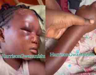 Eight-Year-Old Suffers Swollen Eyes and Hands After Alleged Assault by Aunt