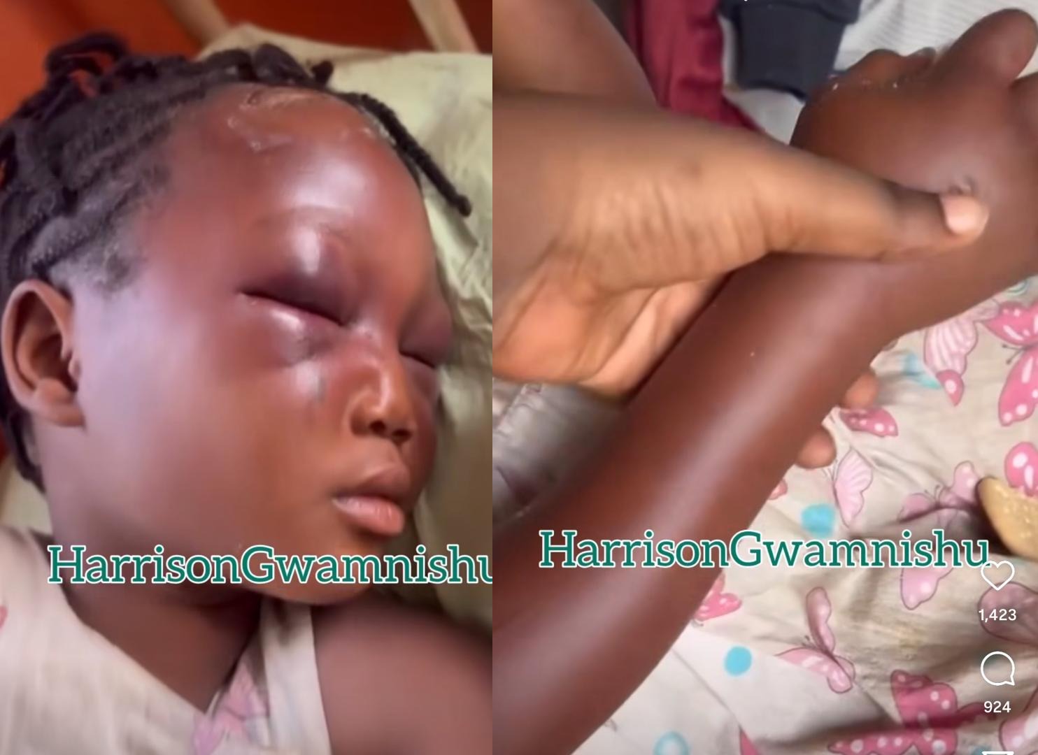 Eight-Year-Old Suffers Swollen Eyes and Hands After Alleged Assault by Aunt